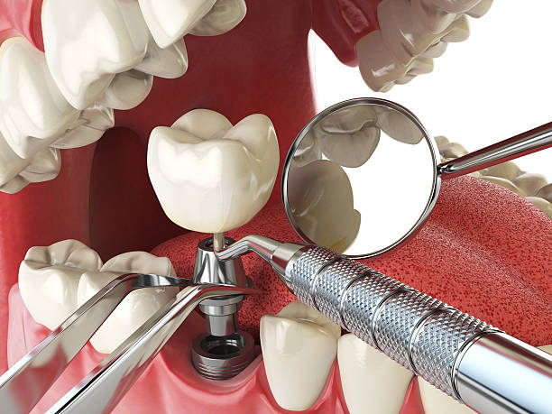 Best Emergency Gum Treatment in Decatur, MI